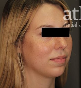 Revision Rhinoplasty Before & After
