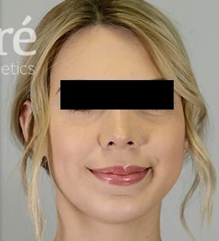 Revision Rhinoplasty Before & After