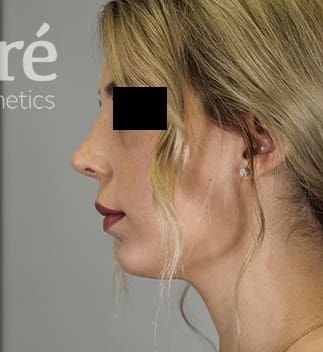 Revision Rhinoplasty Before & After