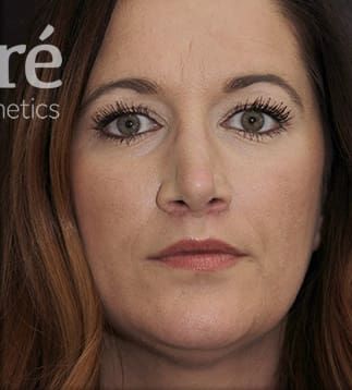 Revision Rhinoplasty Before & After