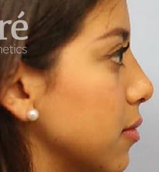 Revision Rhinoplasty Before & After