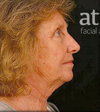 Revision Rhinoplasty Before & After