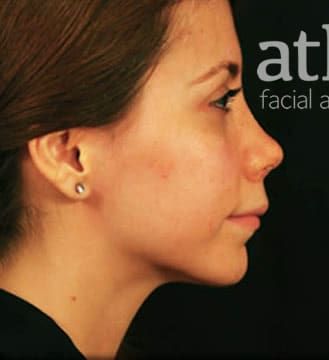 Revision Rhinoplasty Before & After