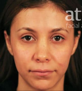 Revision Rhinoplasty Before & After