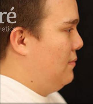 Revision Rhinoplasty Before & After