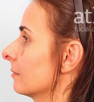 Revision Rhinoplasty Before & After