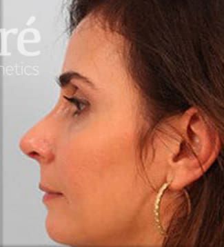 Revision Rhinoplasty Before & After
