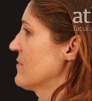 Revision Rhinoplasty Before & After