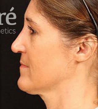 Revision Rhinoplasty Before & After
