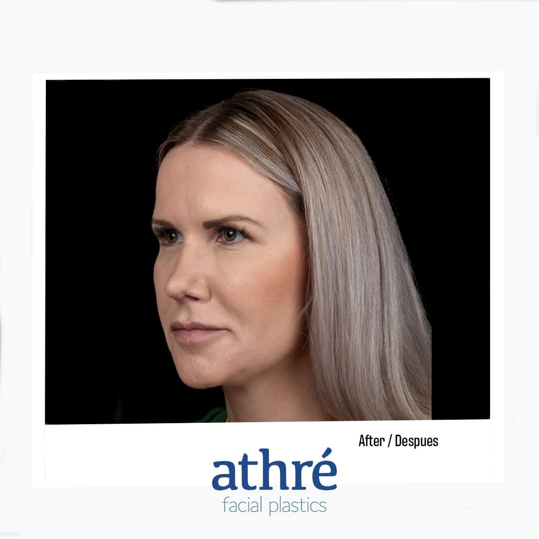 Revision Rhinoplasty Before & After