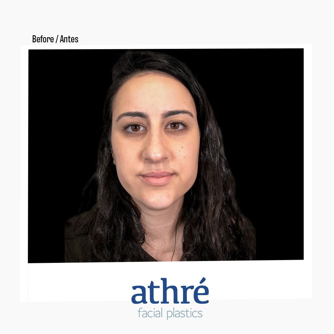 Revision Rhinoplasty Before & After