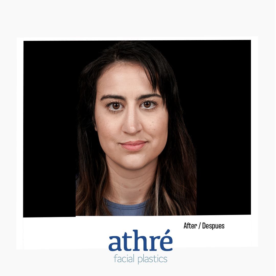 Revision Rhinoplasty Before & After