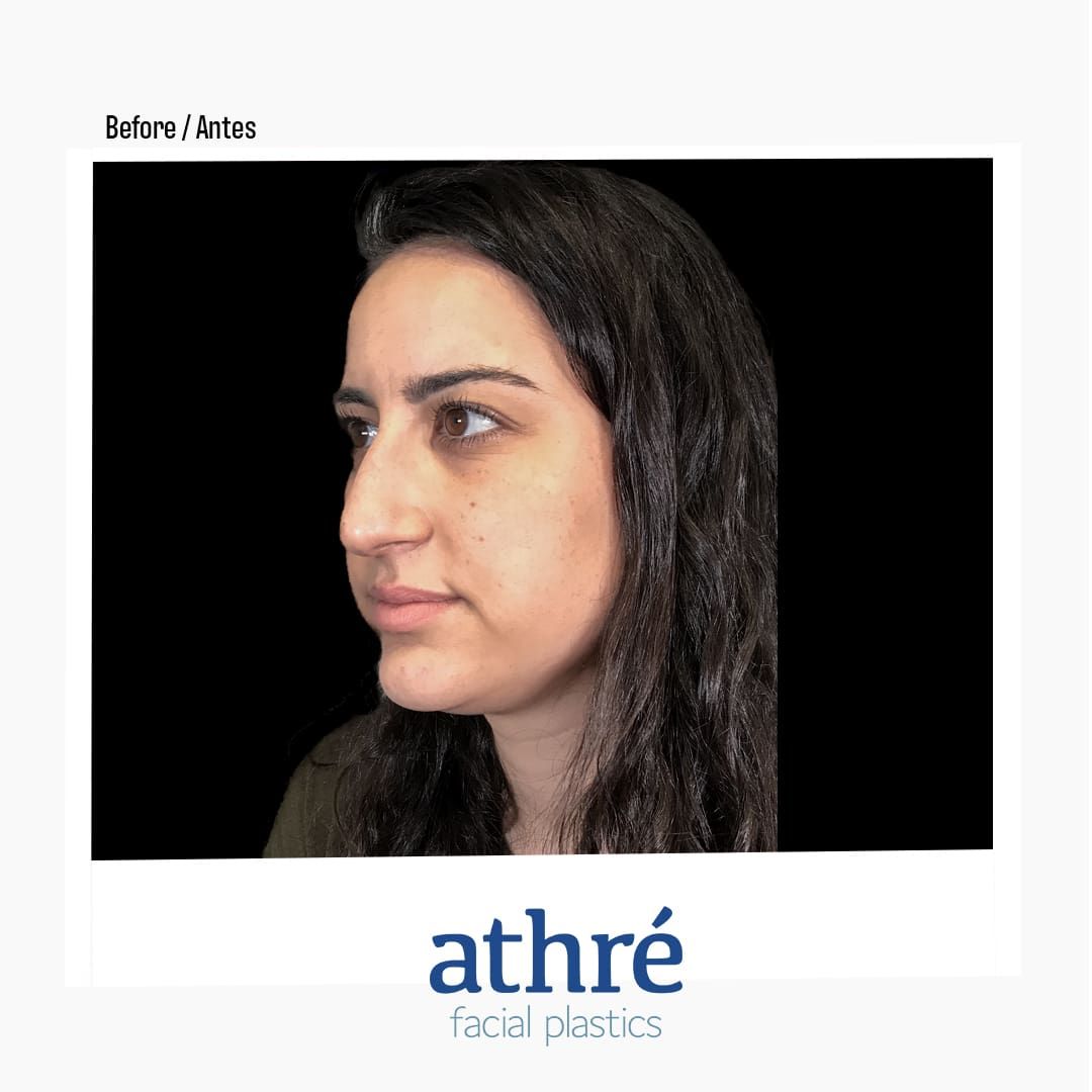 Revision Rhinoplasty Before & After