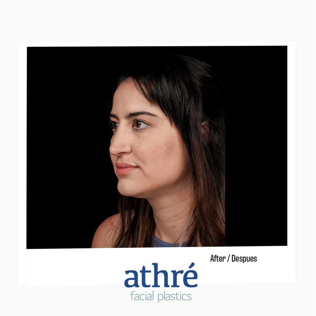 Revision Rhinoplasty Before & After