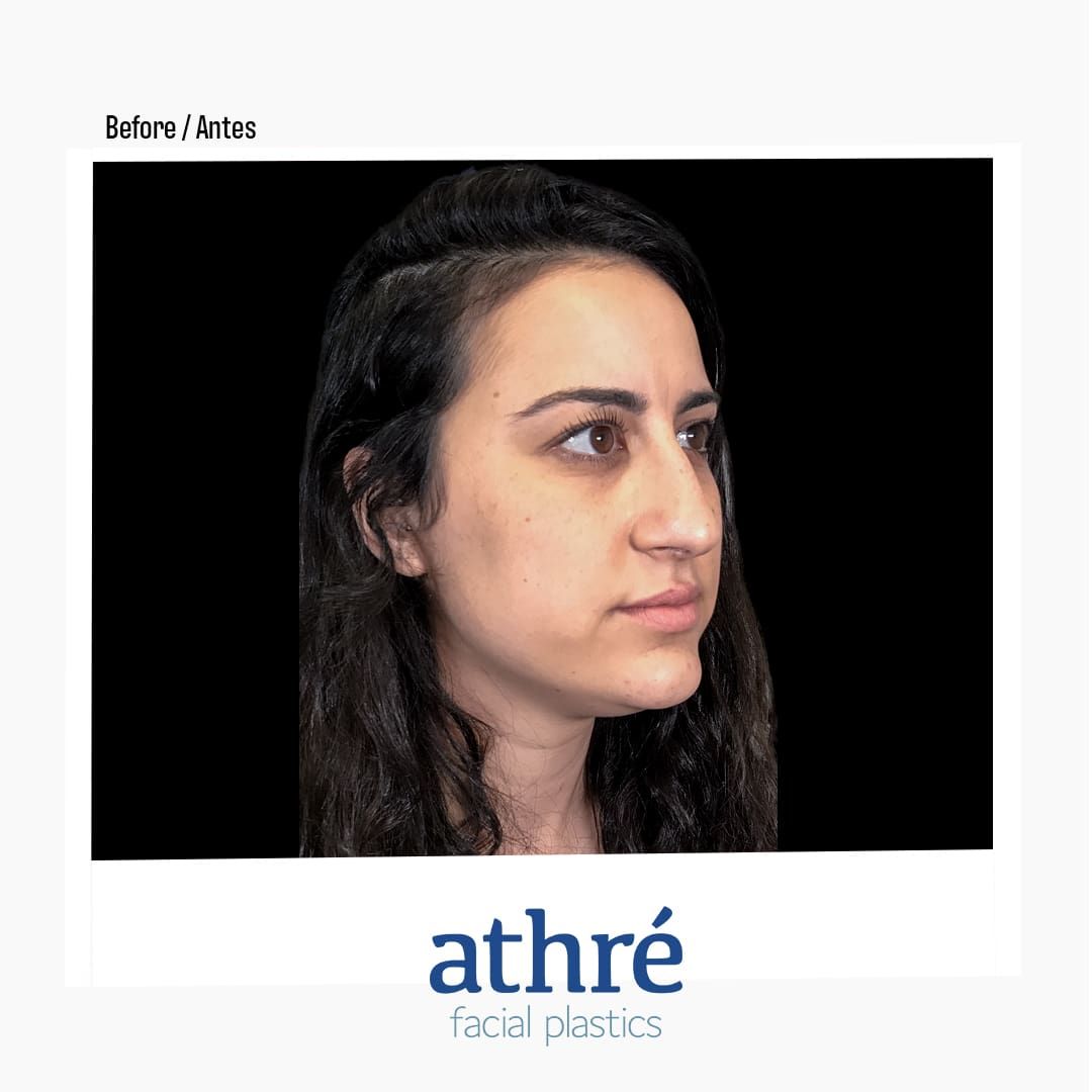 Revision Rhinoplasty Before & After