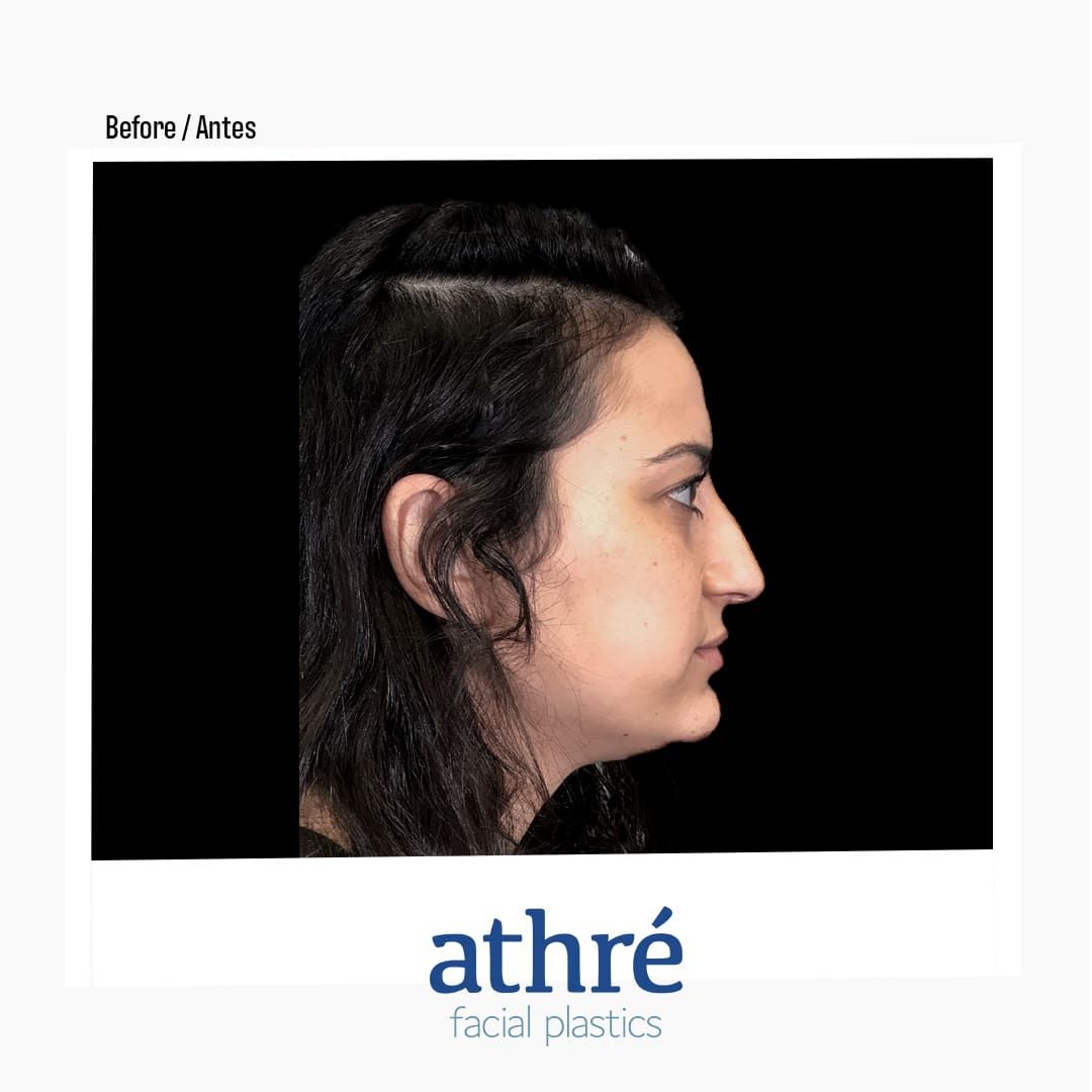 Revision Rhinoplasty Before & After