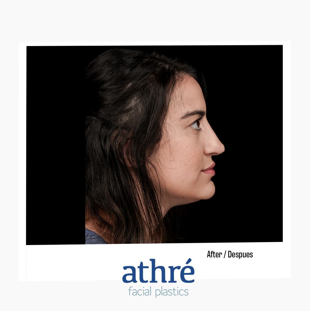 Revision Rhinoplasty Before & After