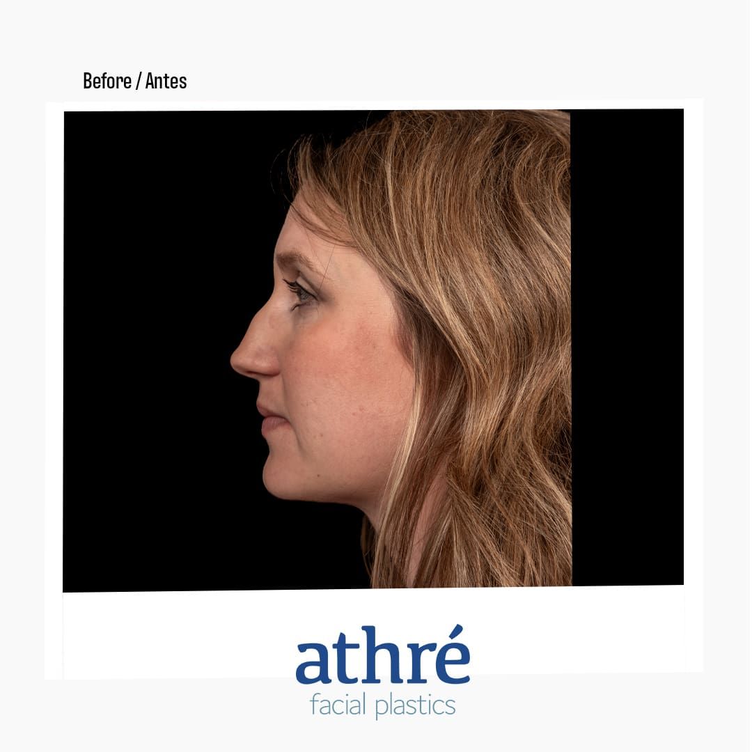 Revision Rhinoplasty Before & After