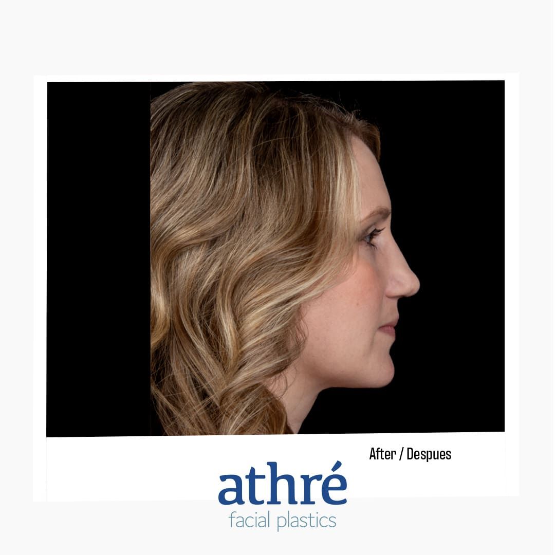Revision Rhinoplasty Before & After