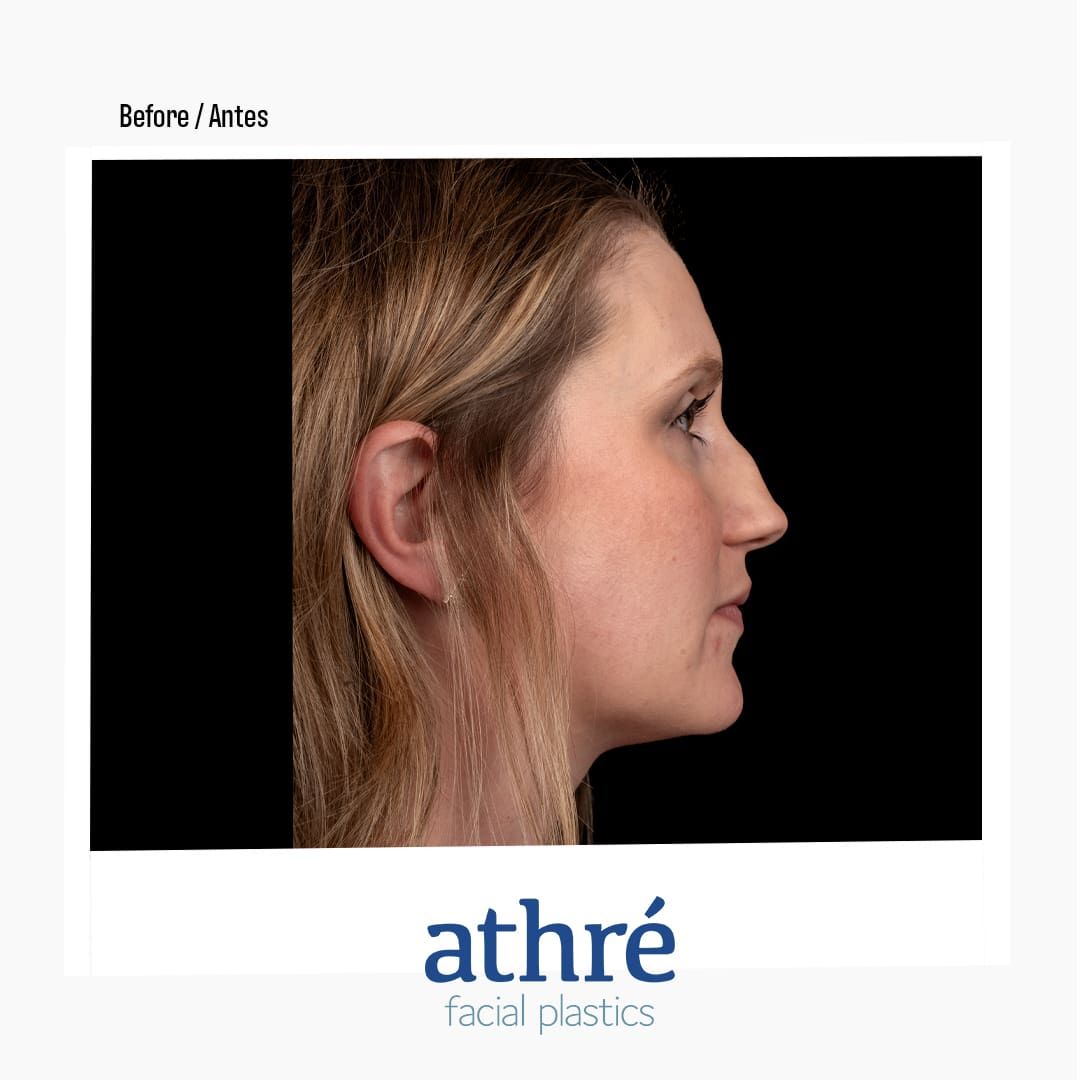 Revision Rhinoplasty Before & After
