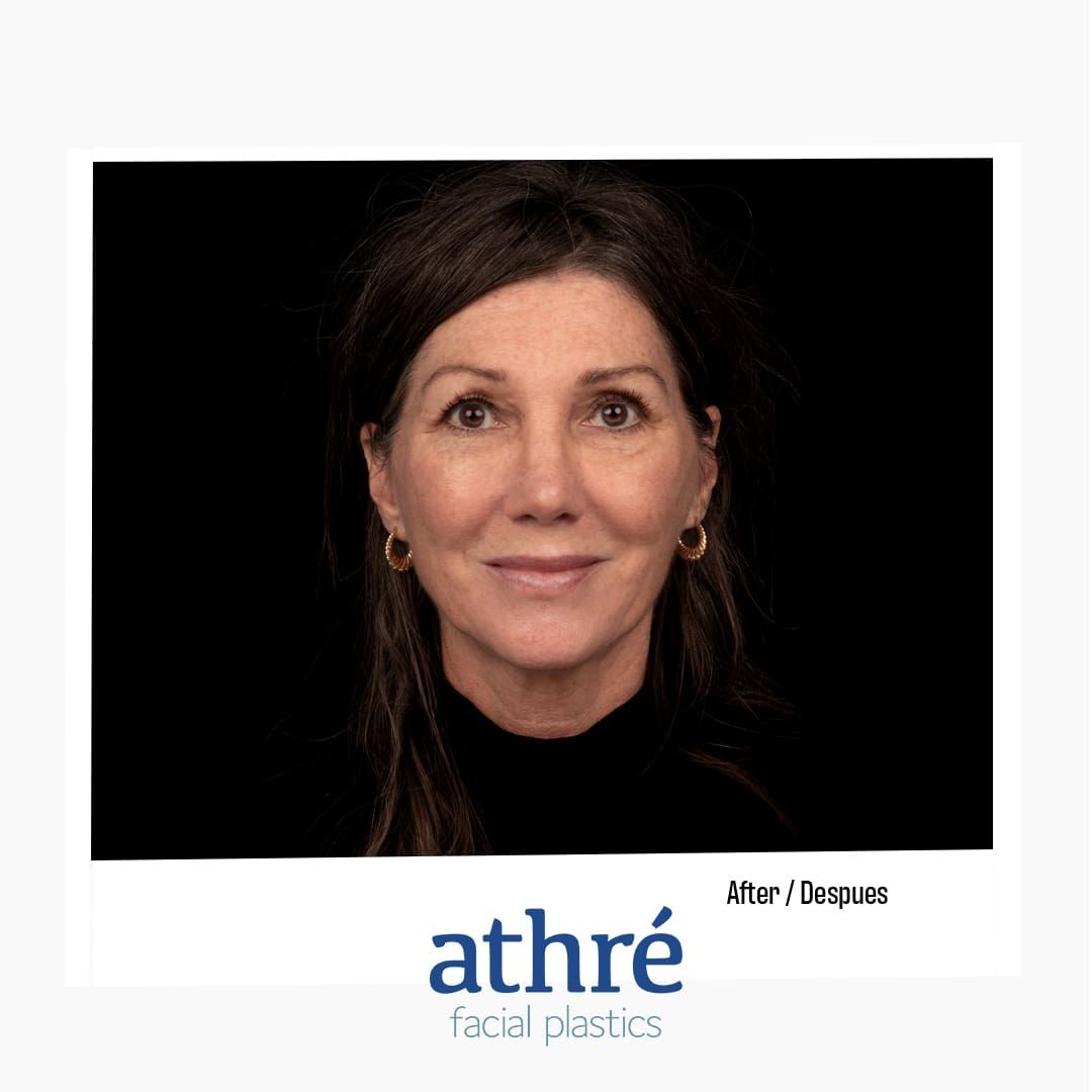 Revision Rhinoplasty Before & After