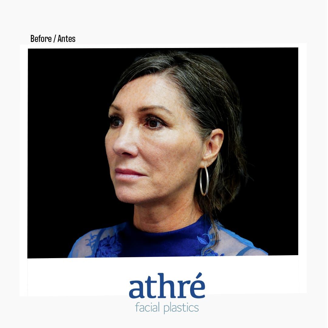 Revision Rhinoplasty Before & After