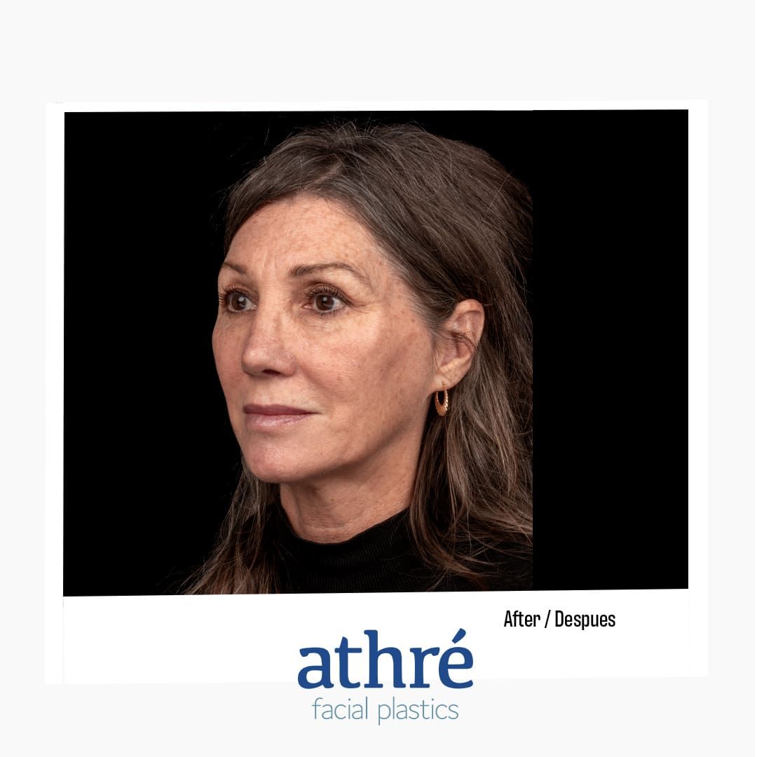 Revision Rhinoplasty Before & After