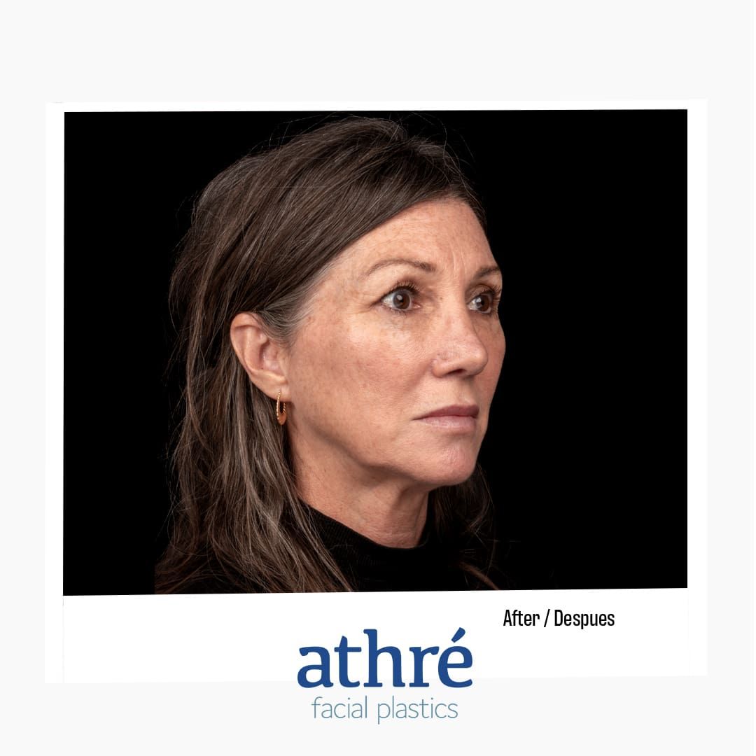 Revision Rhinoplasty Before & After