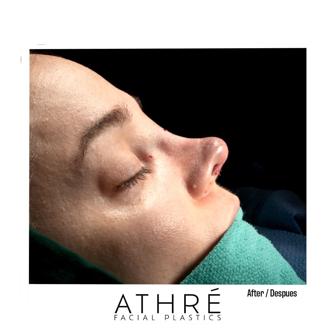 Revision Rhinoplasty Before & After