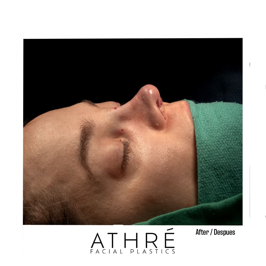 Revision Rhinoplasty Before & After