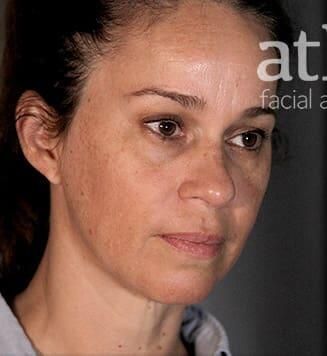 Facial Fat Transfer Before & After