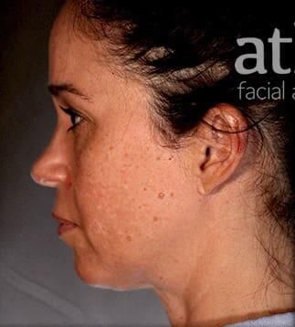 Facial Fat Transfer Before & After