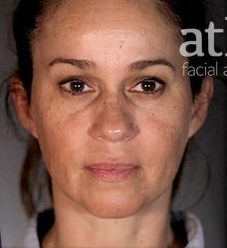 Facial Fat Transfer Before & After
