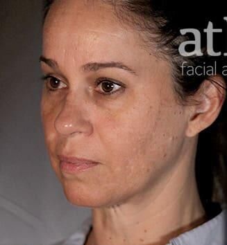 Facial Fat Transfer Before & After