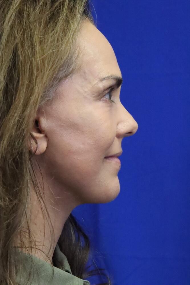 Facial Fat Transfer Before & After