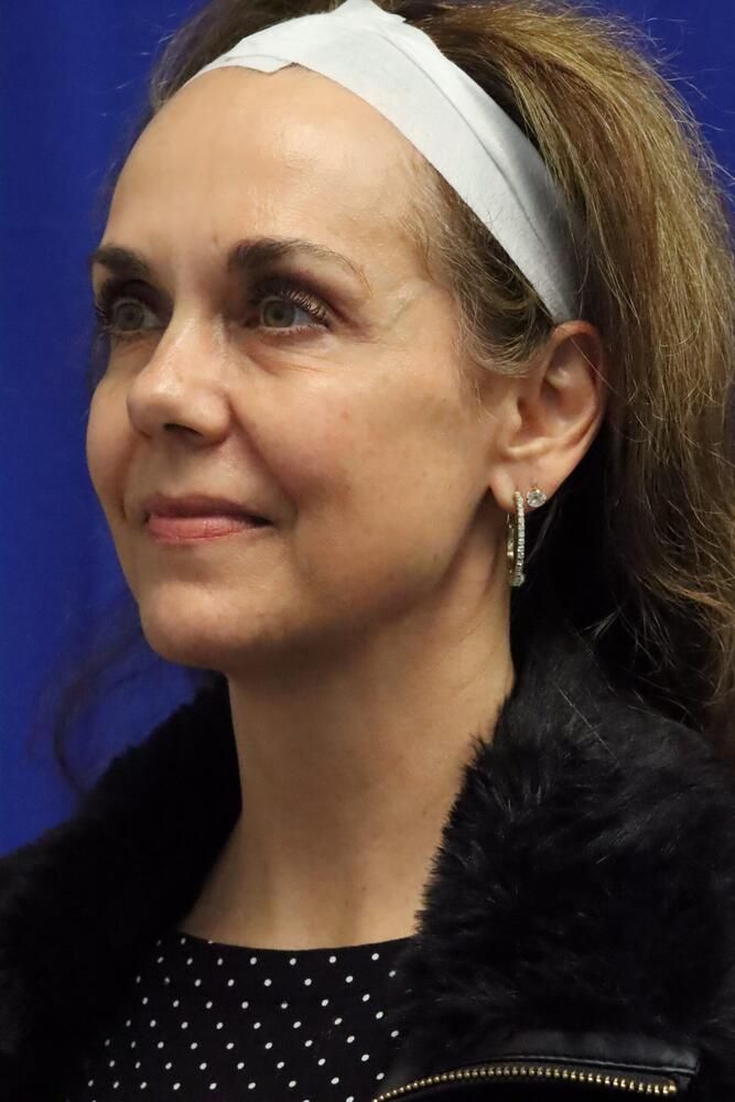 Facial Fat Transfer Before & After