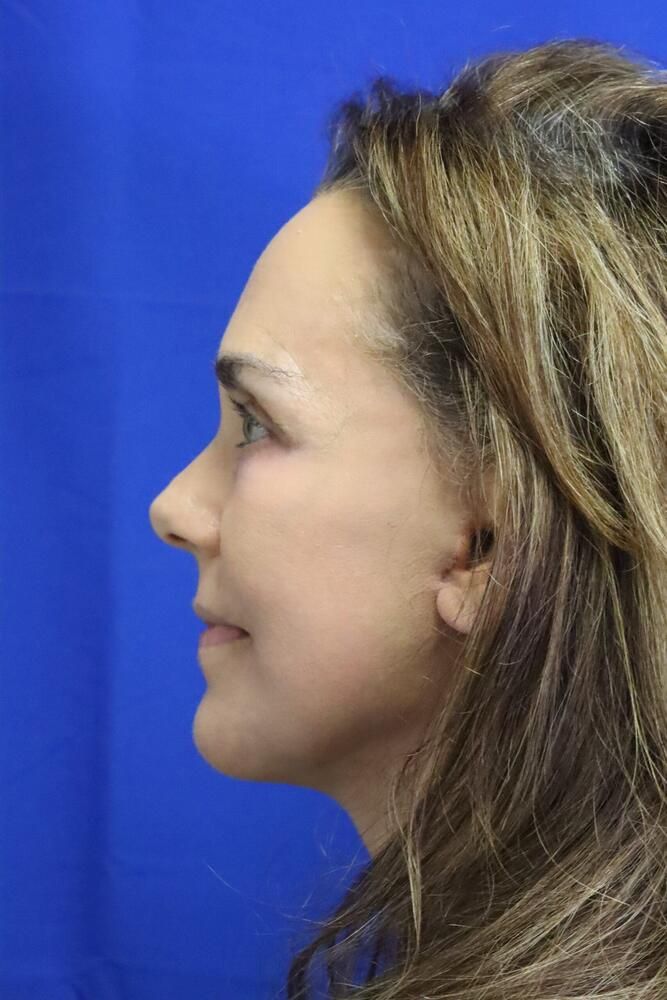 Facial Fat Transfer Before & After