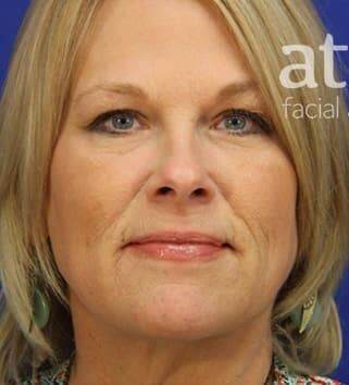 Facial Fat Transfer Before & After