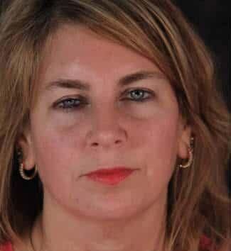 Facial Fat Transfer Before & After