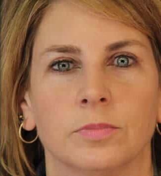 Facial Fat Transfer Before & After