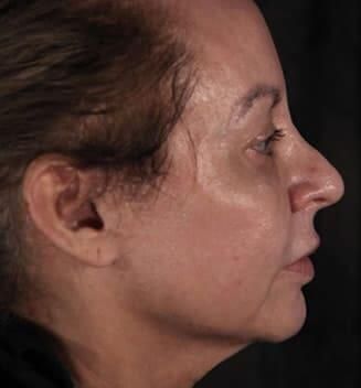 Facial Fat Transfer Before & After