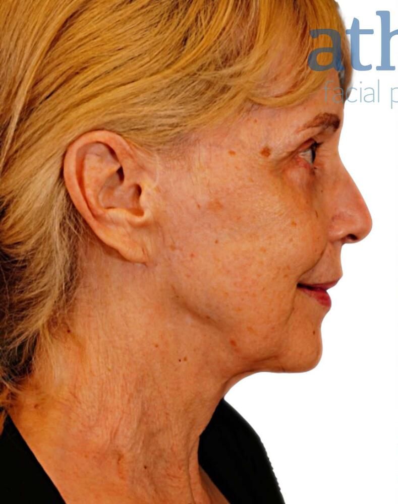 Facial Fat Transfer Before & After