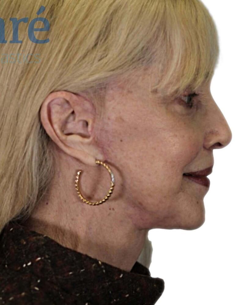 Facial Fat Transfer Before & After