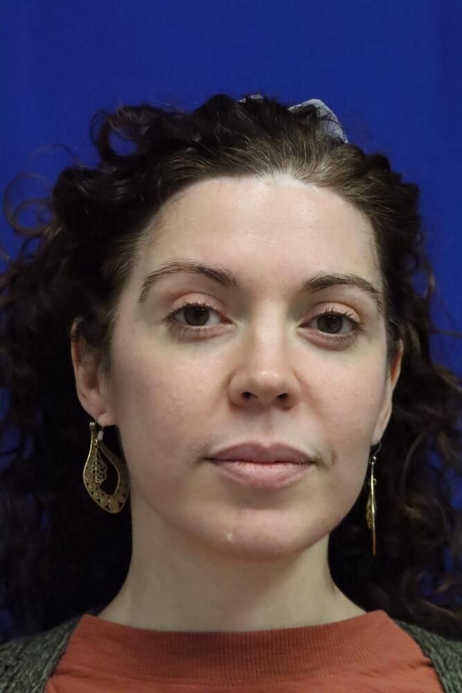 Facial Fat Transfer Before & After