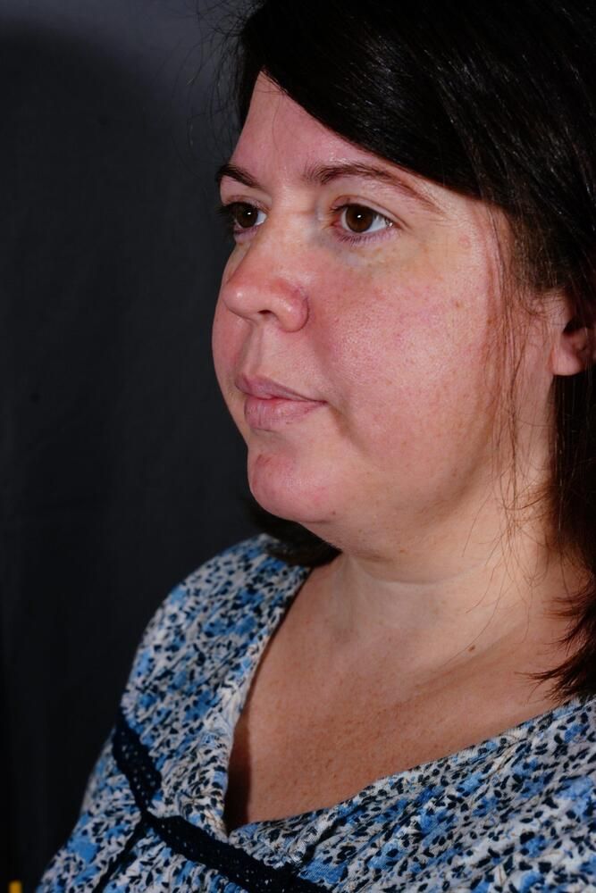 Facial Fat Transfer Before & After