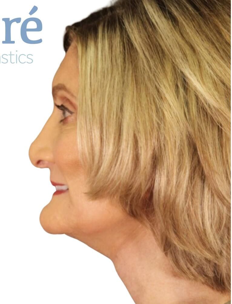 Facial Fat Transfer Before & After