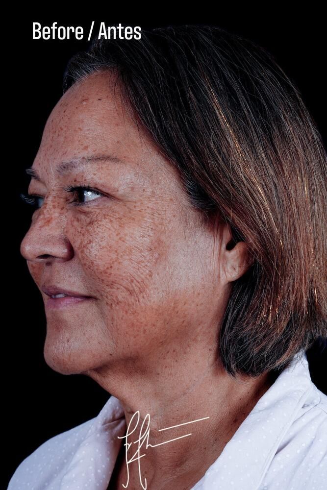 Facial Fat Transfer Before & After