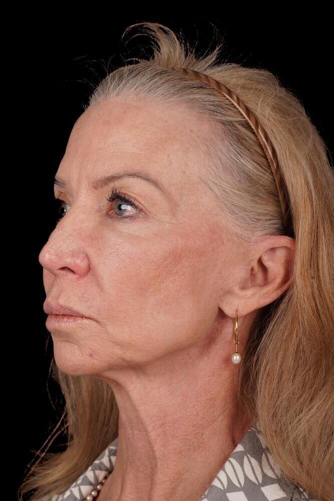 Facial Fat Transfer Before & After