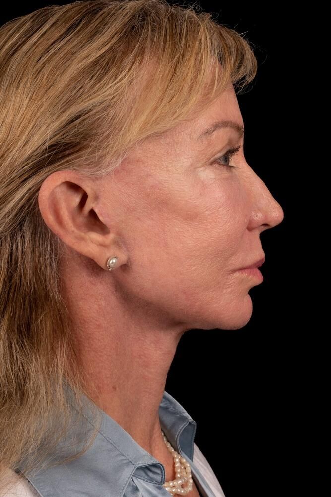 Facial Fat Transfer Before & After