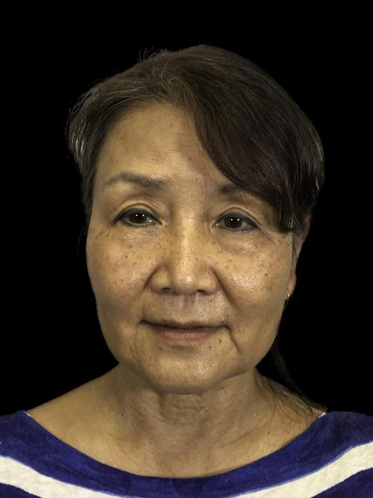 Facial Fat Transfer Before & After